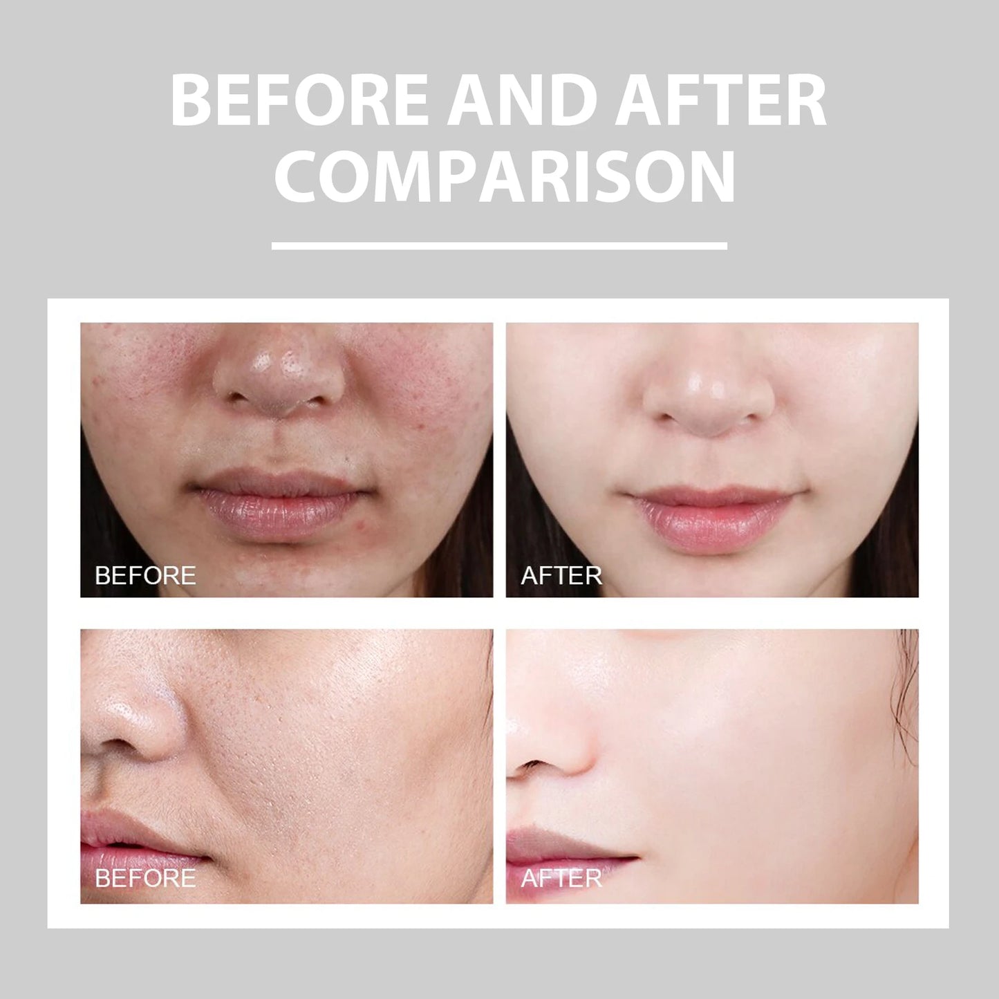 Whitening Cream Anti Freckle Face Cream, Remove The Black，Melasma Dark Spot Acne Deposits On The Skin,Brighten Skin Care